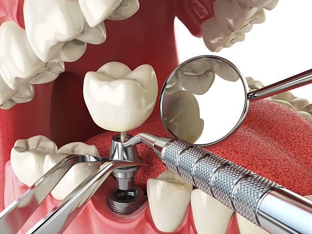 Best Tooth Infection Emergency Dentist  in Sonoma State University, CA
